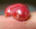 Granula Incision Granuloa Treated Incision Granuloa Treated 1
