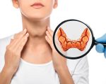 Top 5 Remedies for Hypothyroidism 8