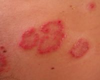 Eczema from Birth 8
