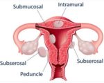 Uterine Fibroids and Homeopathy 2