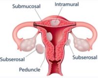 Uterine Fibroids and Homeopathy 5