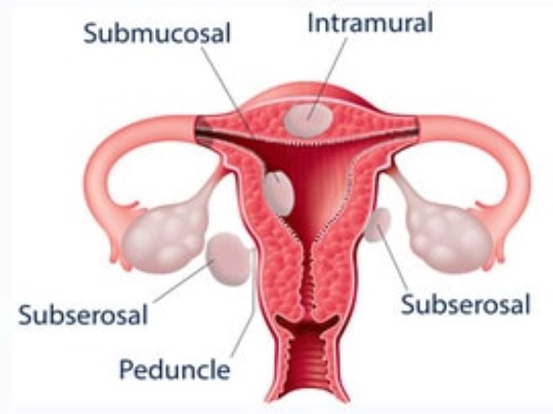 Uterine Fibroids and Homeopathy 1