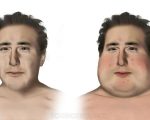 Nephrotic Nephrotic Syndrome Nephrotic Syndrome 1
