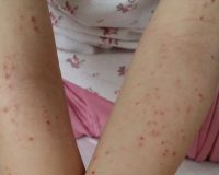 Two Cases of Eczema 5