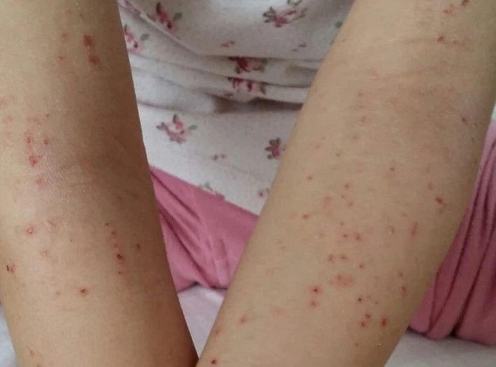 Two Cases of Eczema 2