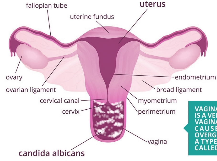 Vaginal Thrush 2