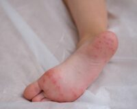 Remedies for Hand, Foot & Mouth Disease 1