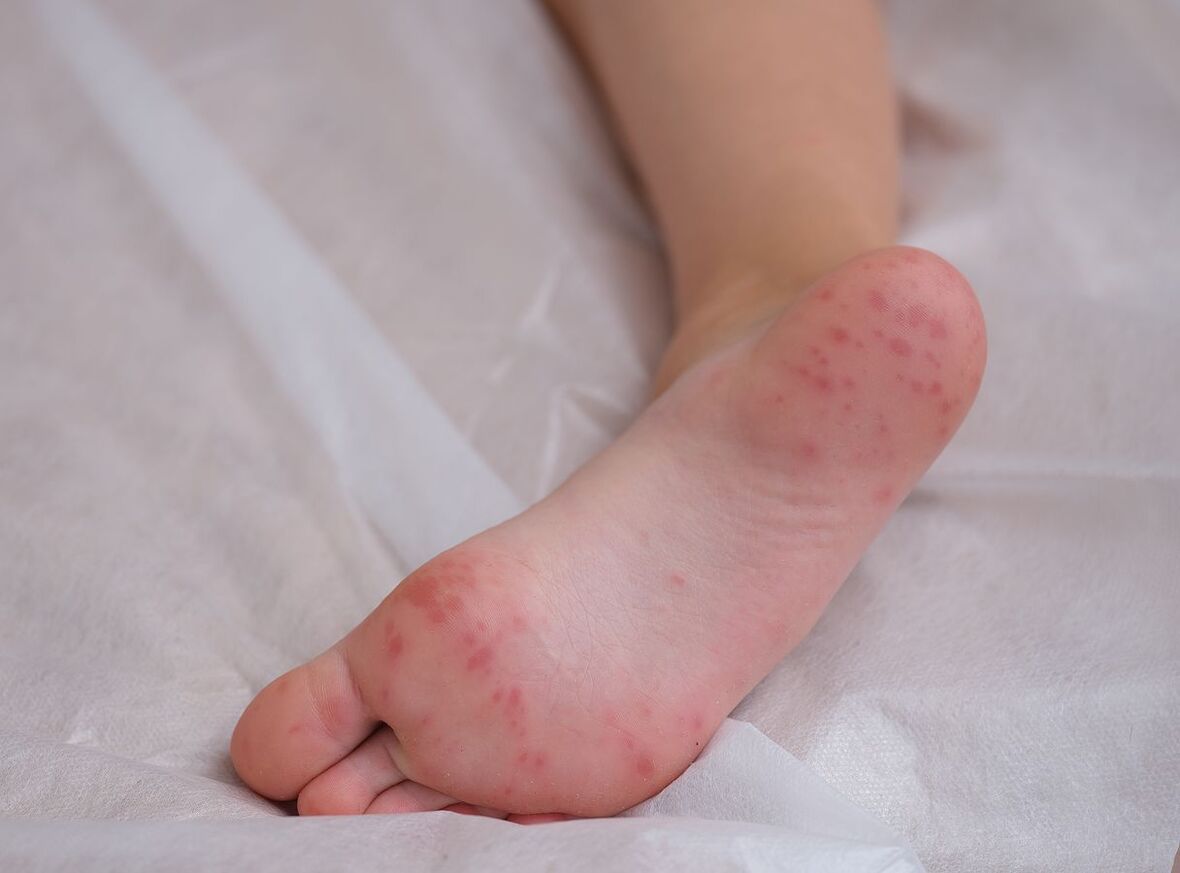 Remedies for Hand, Foot & Mouth Disease 2