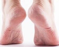 Homeopathy for Achilles Tendinitis 9