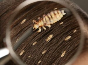 Homeopathy for Head Lice